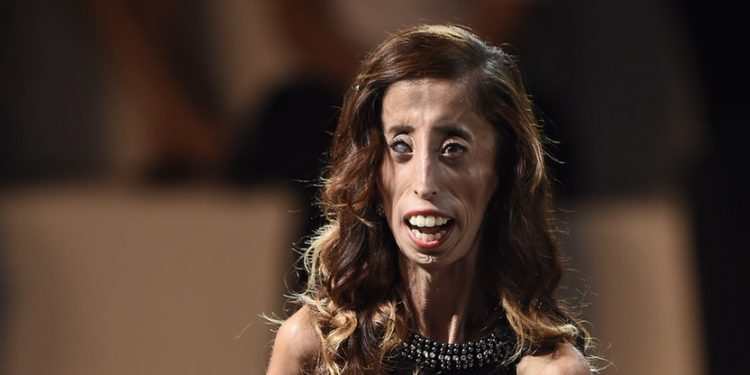 জন্মদিনে ‘বিশ্বের সবচেয়ে কুৎসিৎ মেয়ে’র কাহিনী