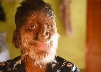 শুধু মাথাই নয়, সারা মুখ জুড়ে গজাচ্ছে চুল! বিরল রোগে আক্রান্ত ভারতীয় যুবক