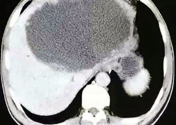 Daily News Reel - Carnivorous Parasites Eating this Human Organ