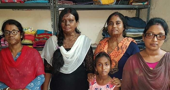 বারুইপুরের তন্দ্রা মাখাল! অ্যাসিডে পুড়েও জ্বলে তার সাহসের আলো